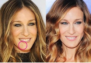 Cost of Mole Removal by Plastic Surgeon