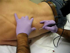 Does Mole Removal Hurt