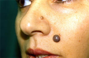 Facial Mole Removal Cost