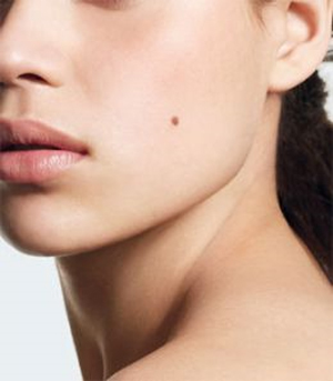 Home Mole Removal Home Mole Removal