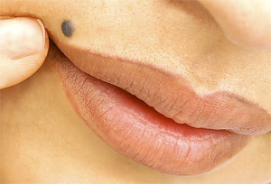 Laser for Mole Removal Laser for Mole Removal