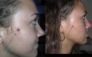 Mole Removal Before and After