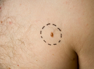 Mole Removal in Essex