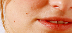 Mole Removal in Ireland