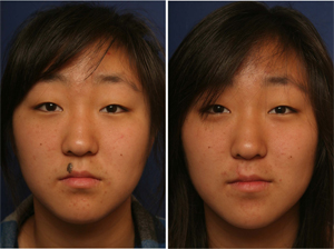 Mole Removal Procedures