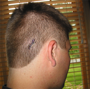 Mole Removal Reviews