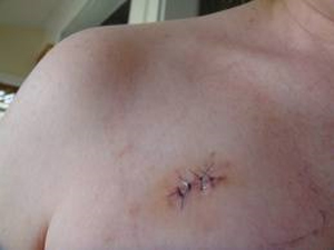 Mole Removal Scarring