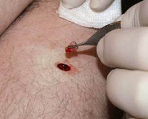 Mole Removal Surgery