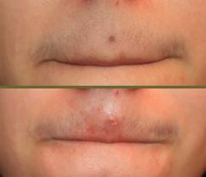 Mole Removal Treatments