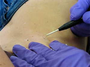 Radio Mole Removal Radio Mole Removal