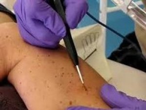 Radiosurgical Mole Removal Radiosurgical Mole Removal