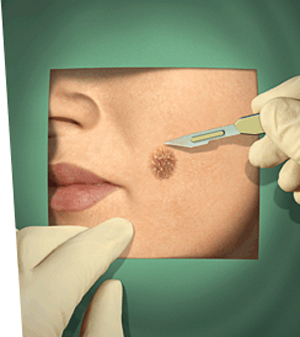 Skin Mole Removal Skin Mole Removal