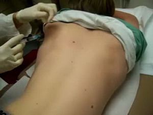 Skin Tag and Mole Removal