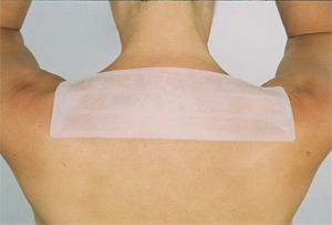 Surgical Mole Removal Scarring